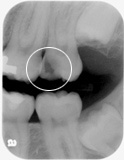 Digital Dental X-Ray Showing Decay