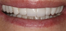 Veneers After