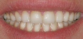 Veneers After