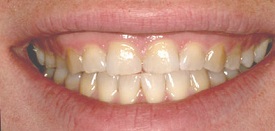 Veneers Before